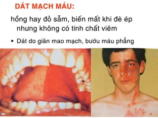 DAÙT MAÏCH MAÙU:
hoàng hay ñoû saãm, bieán maát khi ñeø eùp
 nhöng khoâng coù tính chaát vieâm
 Daùt do giaõn mao maïch, böôùu maùu phaúng
 