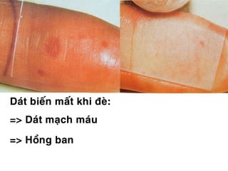 Daùt bieán maát khi ñeø:
=> Daùt maïch maùu
=> Hoàng ban
 