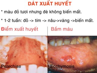 DAÙT XUAÁT HUYEÁT
* maøu ñoû töôi nhöng ñeø khoâng bieán maát.

* 1-2 tuaàn: ñoû -> tím -> naâu->vaøng ->bieán maát.

Ñieåm xuaát huyeát         Baàm maùu




Petechiae                  Ecchymosis
 