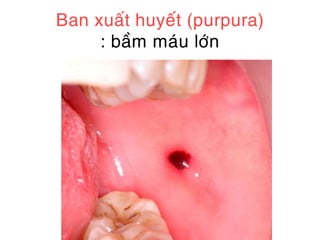 Ban xuaát huyeát (purpura)
     : baàm maùu lôùn
 
