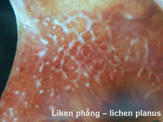 Liken phaúng – lichen planus
 