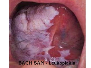 BAÏCH SAÛN - Leukoplakia
 
