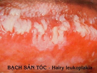 BAÏCH SAÛN TOÙC - Hairy leukoplakia
 