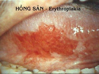 HOÀNG SAÛN - Erythroplakia
 