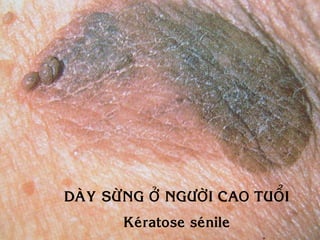 DAØY SÖØNG ÔÛ NGÖÔØI CAO TUOÅI
       Keùratose seùnile
 