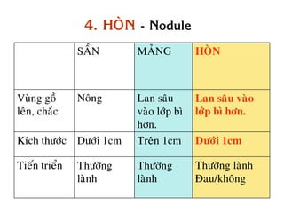 4. HOØN - Nodule
               SAÀN      MAÛNG          HOØN



Vuøng goà      Noâng     Lan saâu       Lan saâu vaøo
leân, chaéc              vaøo lôùp bì   lôùp bì hôn.
                         hôn.
Kích thöôùc Döôùi 1cm    Treân 1cm      Döôùi 1cm

Tieán trieån   Thöôøng   Thöôøng        Thöôøng laønh
               laønh     laønh          Ñau/khoâng
 