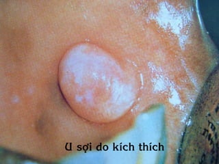 U sôïi do kích thích
 