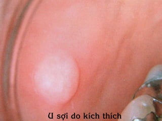 U sôïi do kích thích
 