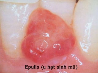 Epulis (u haït sinh muõ)
 