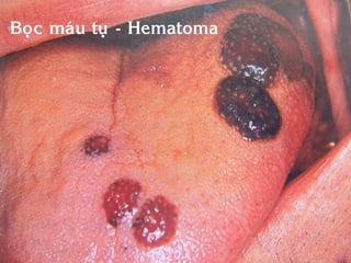 Boïc maùu tuï - Hematoma
 