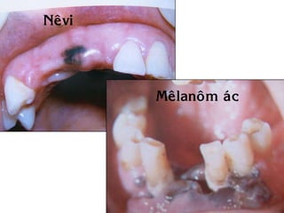 Neâvi




        Meâlanoâm aùc
 