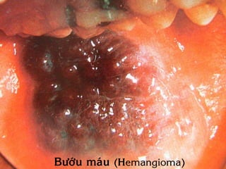 Böôùu maùu (Hemangioma)
 