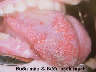 Böôùu maùu & Böôùu baïch maïch
 