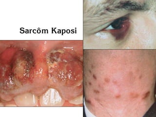 Sarcoâm Kaposi
 