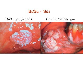 Böôùu - Suøi
Böôùu gai (u nhuù)      Ung thö teá baøo gai
 