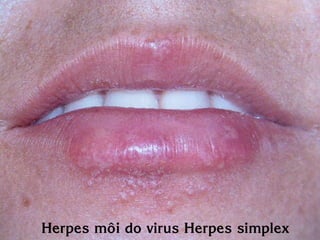 Herpes moâi do virus Herpes simplex
 