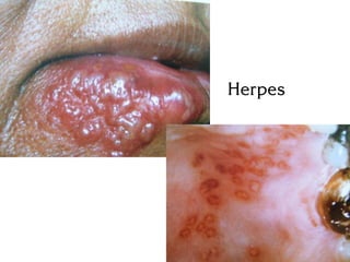 Herpes
 