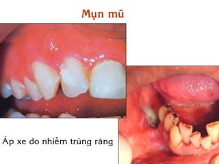 Muïn muõ




AÙp xe do nhieãm truøng raêng
 