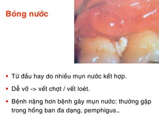 Boùng nöôùc




 Töø ñaàu hay do nhieàu muïn nöôùc keát hôïp.

 Deã vôõ -> veát chôït / veát loeùt.

 Beänh naëng hôn beänh gaây muïn nöôùc: thöôøng gaëp
  trong hoàng ban ña daïng, pemphigus…
 