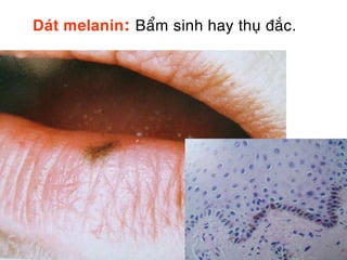 Daùt melanin: Baåm sinh hay thuï ñaéc.
 