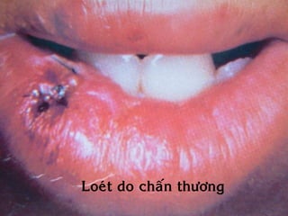 Loeùt do chaán thöông
 