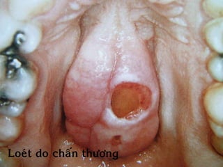 Loeùt do chaán thöông
 