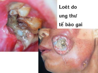 Loeùt do
ung thö
teá baøo gai
 