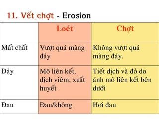 11. Veát chôït - Erosion
                   Loeùt                   Chôït

Maát chaát   Vöôït quaù maøng    Khoâng vöôït quaù
             ñaùy                maøng ñaùy.

Ñaùy         Moâ lieân keát,     Tieát dòch vaø ñoû do
             dòch vieâm, xuaát   aùnh moâ lieân keát beân
             huyeát              döôùi

Ñau          Ñau/khoâng          Hôi ñau
 