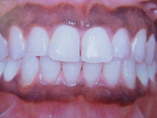 Daùt melanin: Baåm sinh hay thuï ñaéc.
 