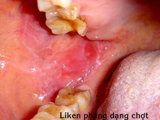 Liken phaúng daïng chôït
 