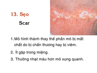 13. Seïo
     Scar


1.Moâ hình thaønh thay theá phaàn moâ bò maát
  chaát do bò chaán thöông hay bò vieâm.
2. Ít gaëp trong mieäng.
3. Thöôøng nhaït maøu hôn moâ xung quanh.
 