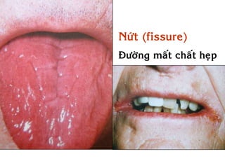 Nöùt (fissure)
Ñöôøng maát chaát heïp
 