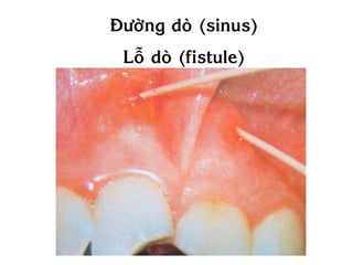 Ñöôøng doø (sinus)
 Loã doø (fistule)
 