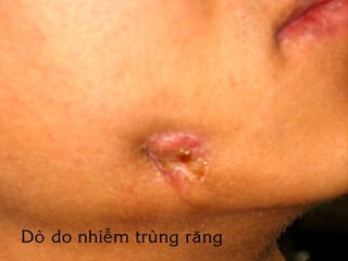 Doø do nhieãm truøng raêng
 