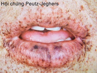 Hoäi chöùng Peutz-Jeghers
 