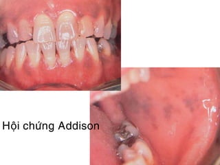 Hoäi chöùng Addison
 
