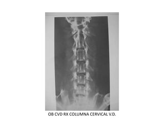 5 Radiologia De Columna | PDF