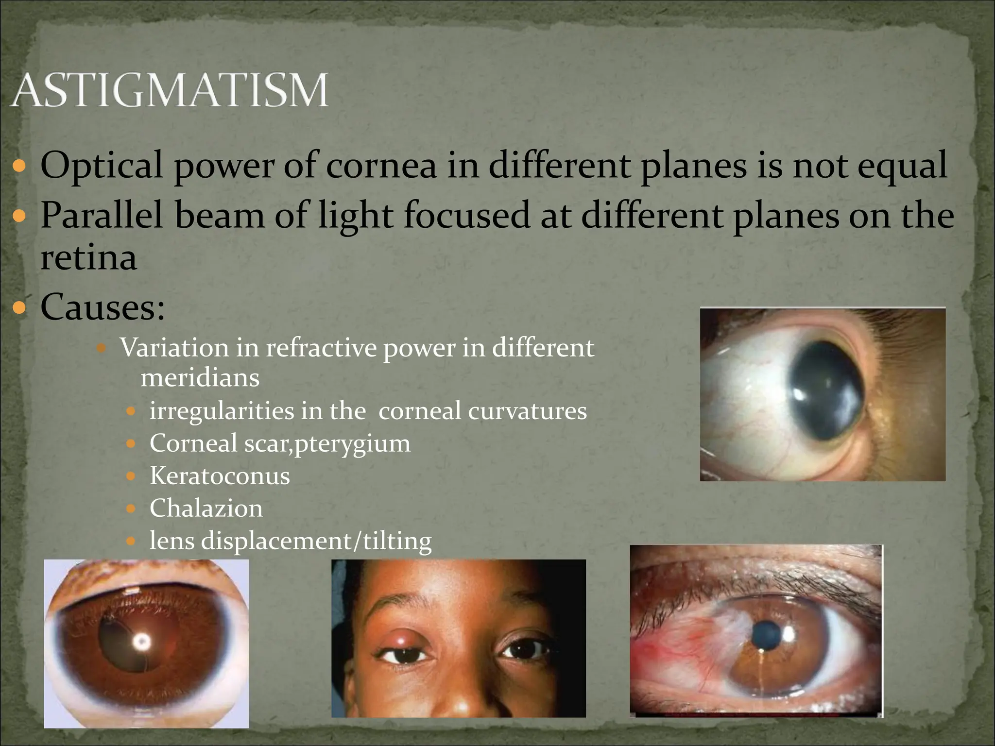 Optical power of cornea in different planes is not equal
 Parallel beam of light focused at different planes on the
retina
 Causes:
 Variation in refractive power in different
meridians
 irregularities in the corneal curvatures
 Corneal scar,pterygium
 Keratoconus
 Chalazion
 lens displacement/tilting
 