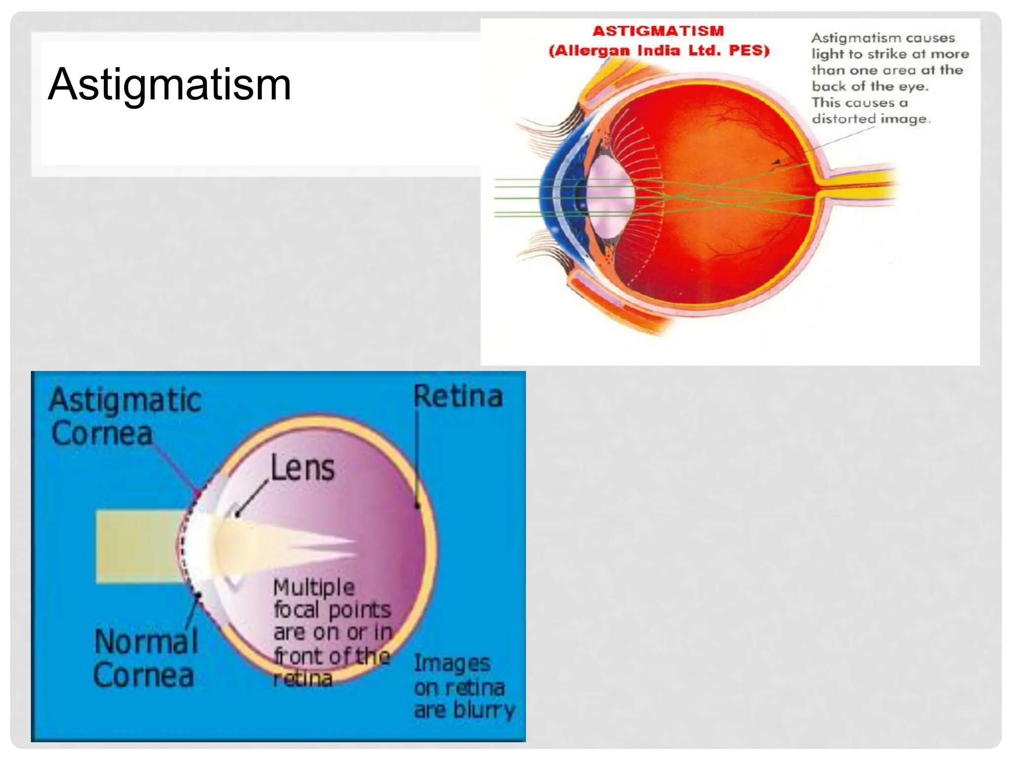 Astigmatism
 