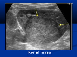 Renal mass
 