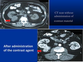 CT scan withoutCT scan without
administration ofadministration of
contrast materialcontrast material
After administration
of the contrast agent
 