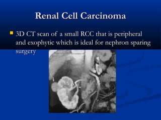 Renal Cell CarcinomaRenal Cell Carcinoma
 3D CT scan of a small RCC that is peripheral3D CT scan of a small RCC that is peripheral
and exophytic which is ideal for nephron sparingand exophytic which is ideal for nephron sparing
surgerysurgery
 
