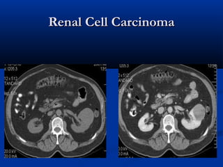 Renal Cell CarcinomaRenal Cell Carcinoma
 