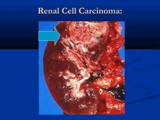 Renal Cell Carcinoma:Renal Cell Carcinoma:
 