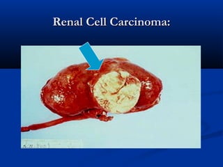 Renal Cell Carcinoma:Renal Cell Carcinoma:
 