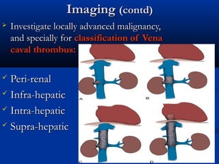 ImagingImaging (contd)(contd)
 Investigate locally advanced malignancy,Investigate locally advanced malignancy,
and specially forand specially for classification of Venaclassification of Vena
caval thrombus:caval thrombus:
 Peri-renalPeri-renal
 Infra-hepaticInfra-hepatic
 Intra-hepaticIntra-hepatic
 Supra-hepaticSupra-hepatic
 