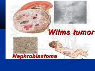 Wilms tumorWilms tumor
NephroblastomaNephroblastoma
 