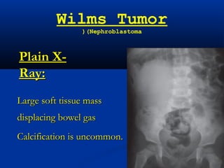 Wilms Tumor
(Nephroblastoma(
Plain X-Plain X-
Ray:Ray:
Large soft tissue massLarge soft tissue mass
displacing bowel gasdisplacing bowel gas
Calcification is uncommon.Calcification is uncommon.
 