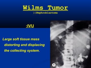 Wilms Tumor
(Nephroblastoma(
IVU:
Large soft tissue mass
distorting and displacing
the collecting system.
 