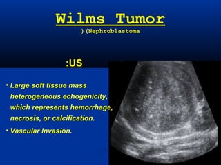 Wilms Tumor
(Nephroblastoma(
US:
• Large soft tissue mass
heterogeneous echogenicity,
which represents hemorrhage,
necrosis, or calcification.
• Vascular Invasion.
 